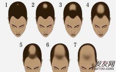 脱发等级一般都是怎么划分的？