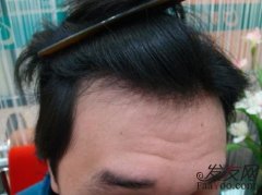 发际线后退了该怎么养回来？