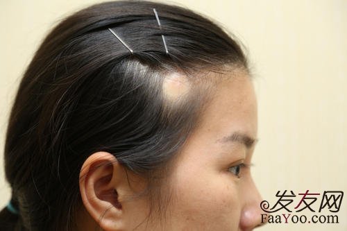 哪些人可以去做植发手术呢?