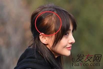 发际线怎么样才算后移呢?