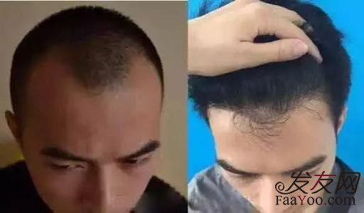 发际线怎么样才算后移呢?