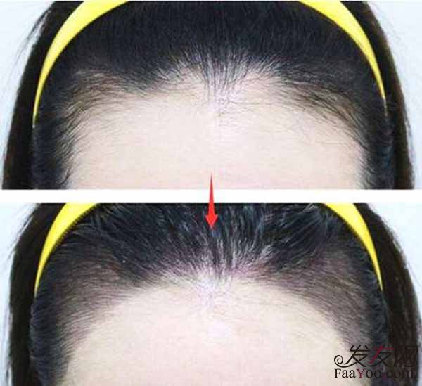 去做美人尖植发效果好吗?