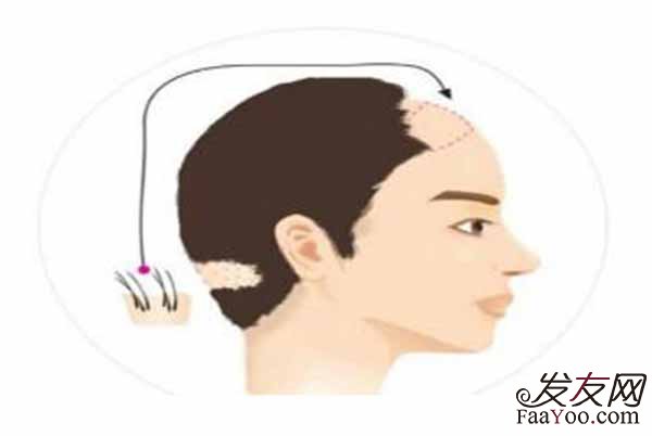 发际线很高是一种什么感觉呢?