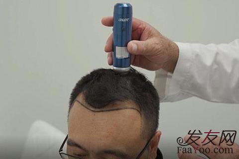 一般脱发可以不治就能好吗?