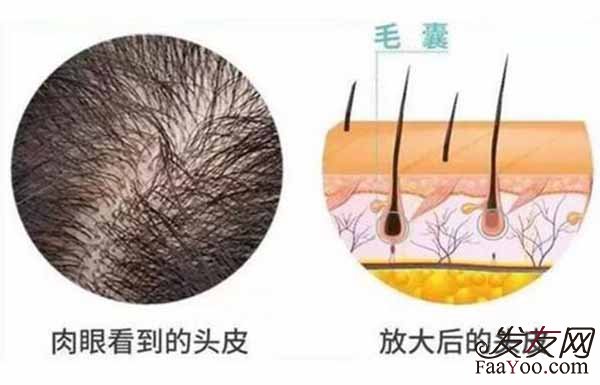 现在的植发技术有哪些优劣势?