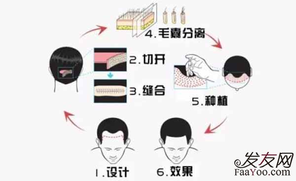 现在的植发技术有哪些优劣势?