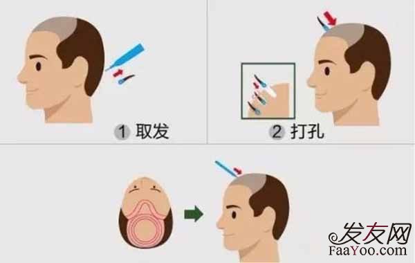 植发手术存在的危害有哪些?
