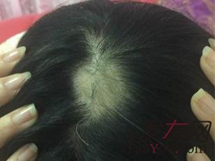 女性出现斑秃有哪些好的治疗方法?