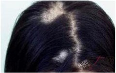 头上出现斑秃是怎么一回事？