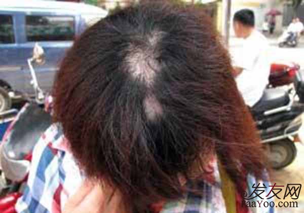 女性经常的烫染发会导致脱发吗？