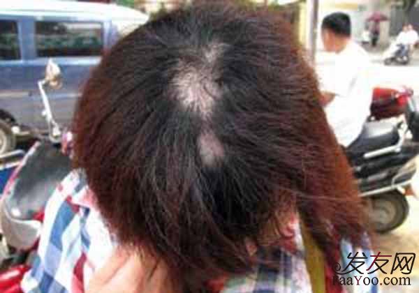 女性经常的烫染发会导致脱发吗?