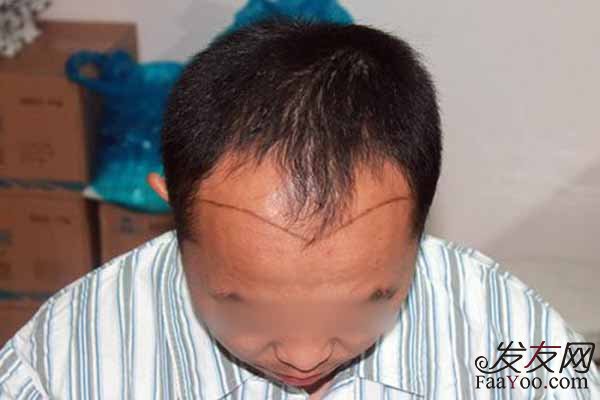 植发术后会出现哪些不适呢?