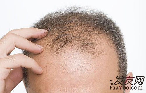 什么原因会导致慢慢变秃头了？