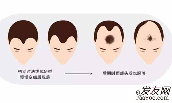 秃头的人那么多为何不去植发了?