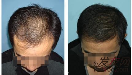 遗传性脱发只能去植发解决吗？