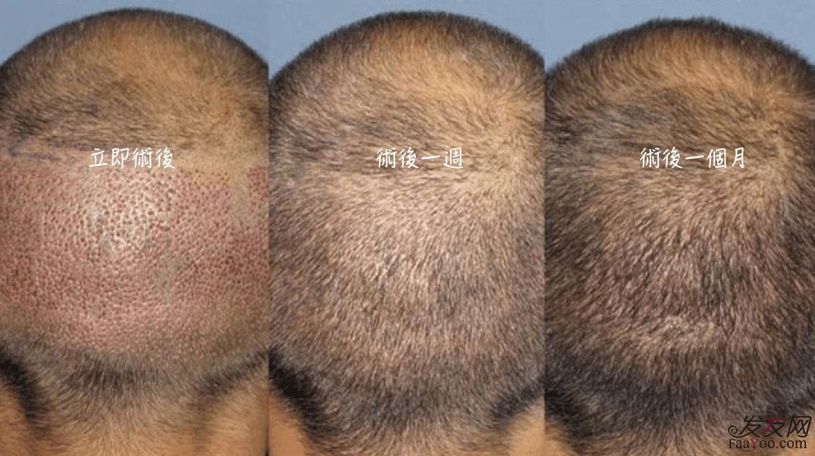植发价格都是怎么定的?