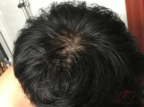控油能防止脂溢性大量脱发吗?