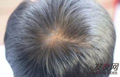 最近头发变少了是脱发了吗？