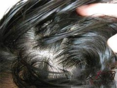 一直掉头发该怎么进行改善？