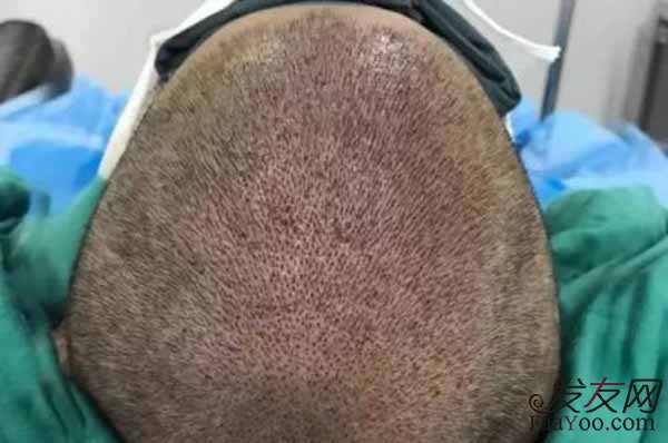 植发医院要怎么选才能选对呢?