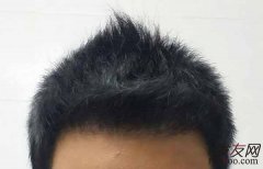 该怎么分辨自己是脱发了呢？