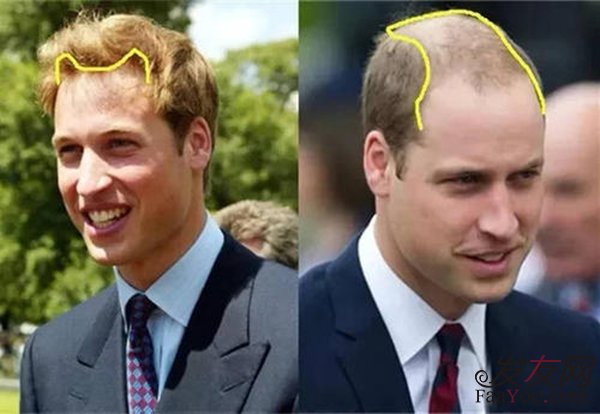 男性中年怎么改善脱发状况?