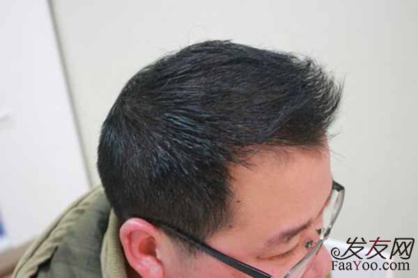 每天掉多少根头发才算是脱发?