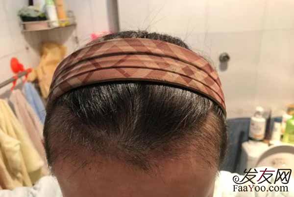 每天掉多少根头发才算是脱发?
