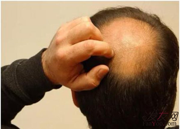 植发分为几个过程？