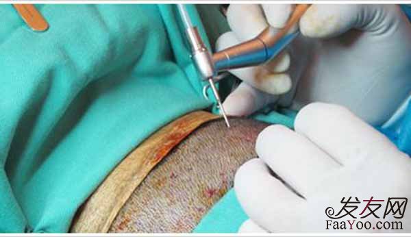 植发分为几个过程？