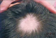 出现鬼剃头的现象是什么原因呢？