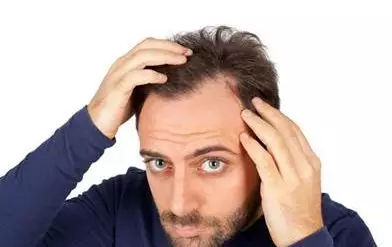 男性型脱发的早期表现症状，你中了几点？