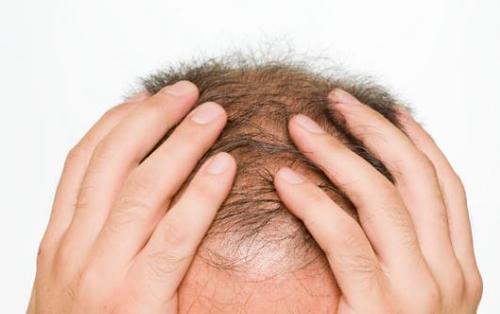 男性脱发的早期症状和误区
