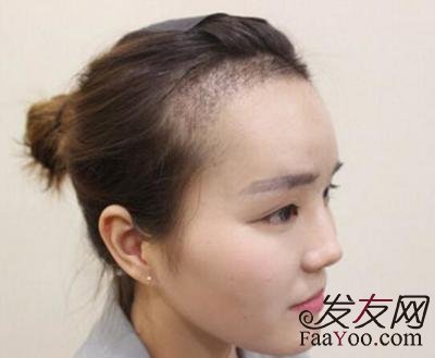 植发手术后应该注意什么？