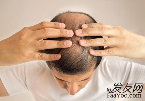 脂溢性脱发的危害和治疗方法