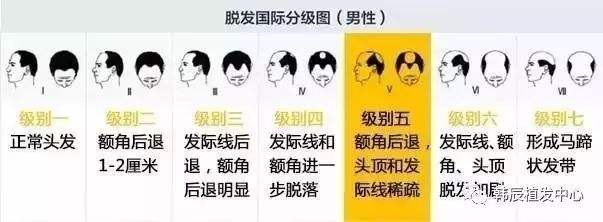 带你解读遗传性脱发,看一看你所不了解的