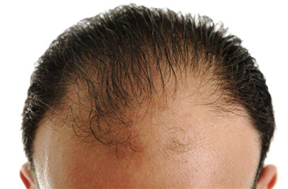 男性爱头油会脱发吗|原因是什么