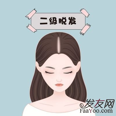 发际线种植应该注意什么？效果怎么样？