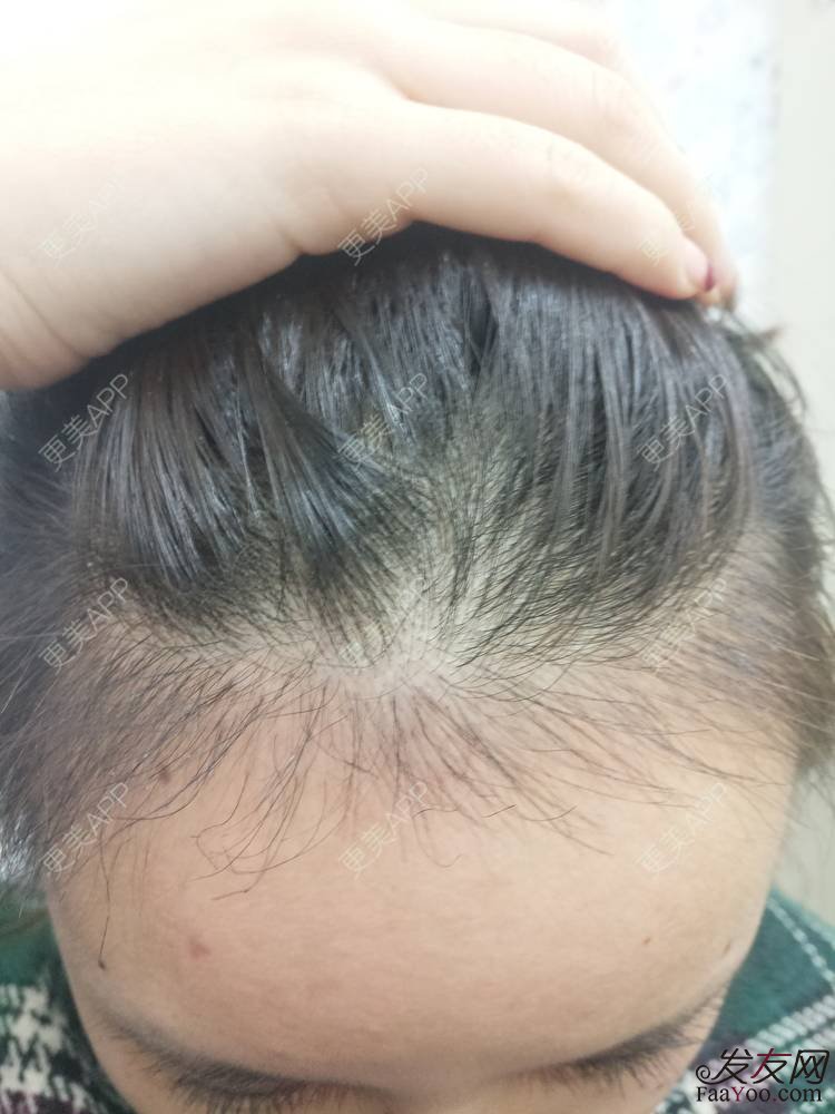 植发后头发会掉落吗？