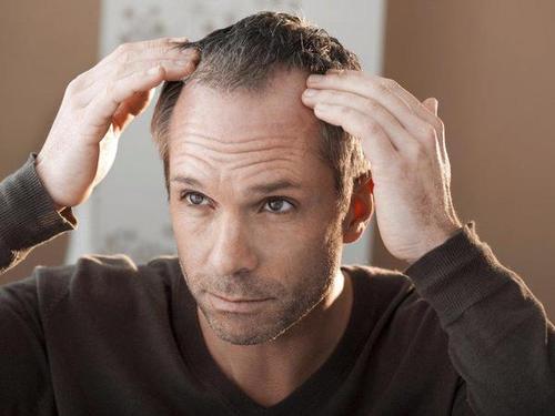 为什么往往男人脱发都很严重？