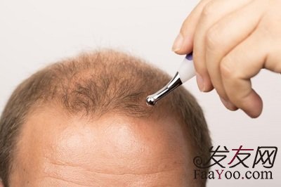 植发手术效果怎么样？多长时间能恢复？