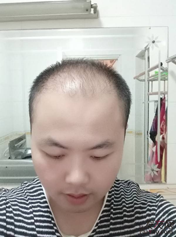 生姜洗发水有什么效果？防脱发吗？