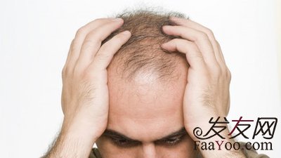 神经性脱发是什么？该怎么治疗？