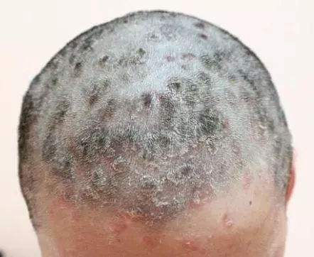 头部脂溢性皮炎