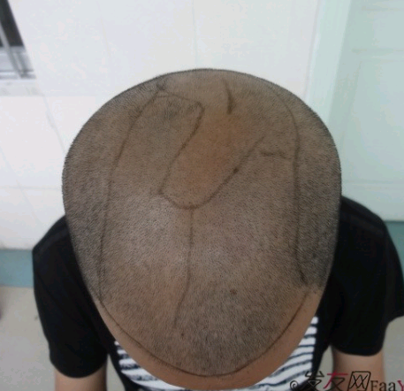 头顶植发案例