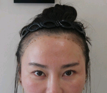 发际线种植案例