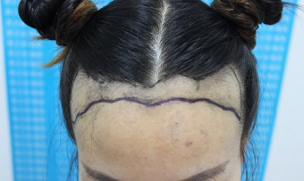 发际线调整植发2000单位，分享我的笔记