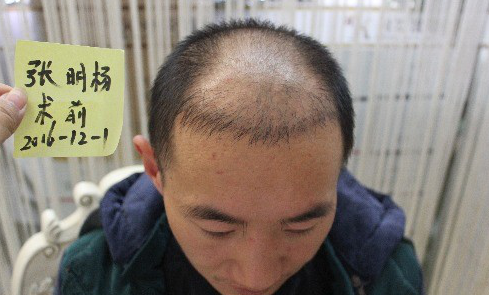 我在上海大麦微针植发后，6个月的效果经历