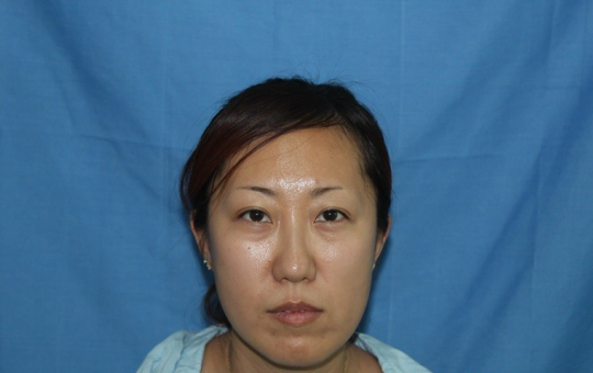 南加高红侠主任眉毛种植术后一年效果植眉案例