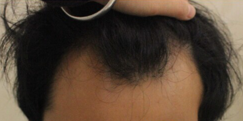 西安大麦微针2800单位慢慢看我蜕变